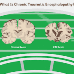 Concussion Syndrome (CTE): Should My Child Play Sports?