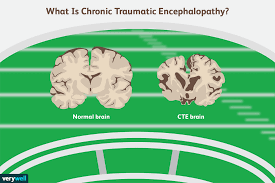 Concussion Syndrome (CTE): Should My Child Play Sports?