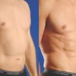 Body Contouring Procedures for Men