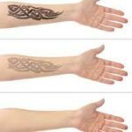 Laser Tattoo Removal