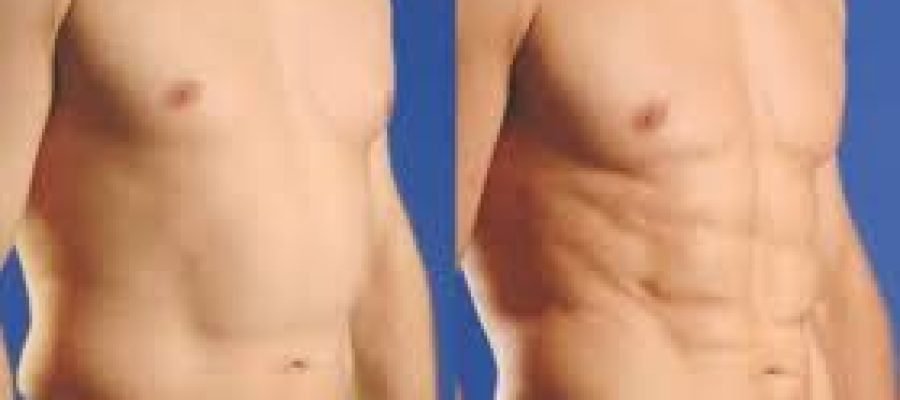 Body Contouring Procedures for Men