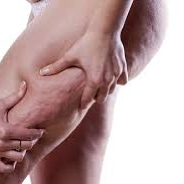 Cellulite