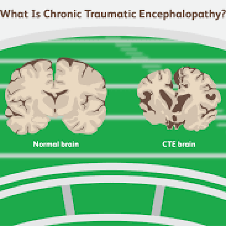 Concussion Syndrome (CTE): Should My Child Play Sports?