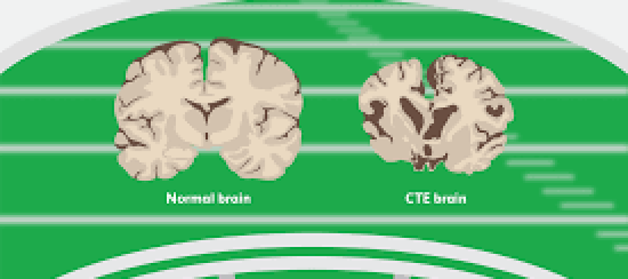 Concussion Syndrome (CTE): Should My Child Play Sports?