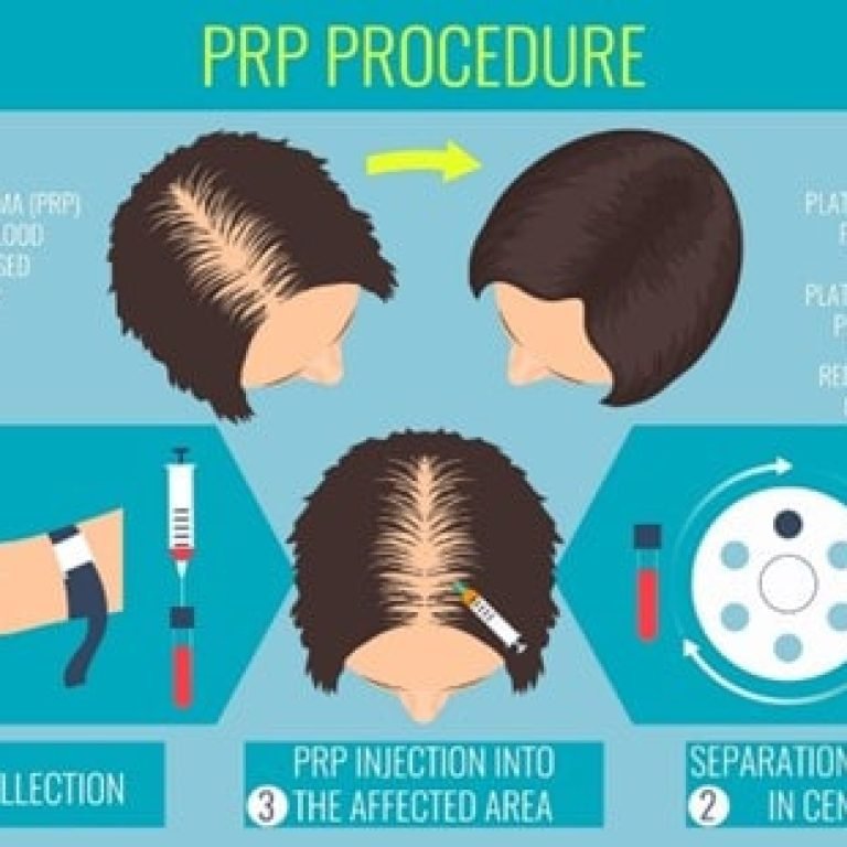 hair transplant