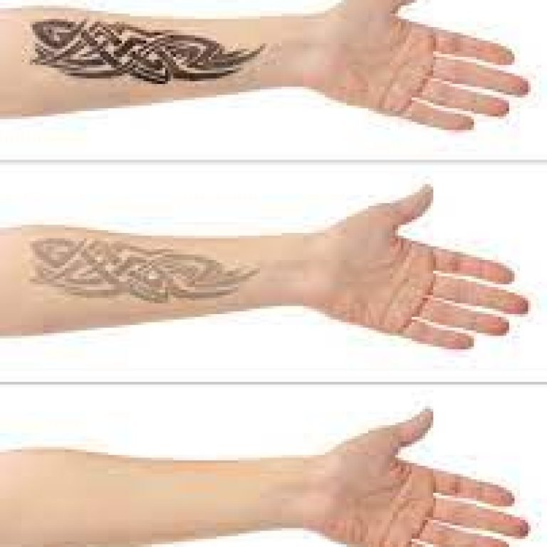 Laser Tattoo Removal