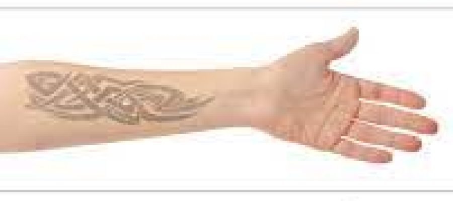 Laser Tattoo Removal